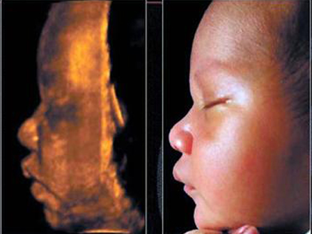 20 Hafta Ayrintili Gebelik Ultrasonografisi Fetal Anomali Tarama Hekimoglu Goruntuleme Merkezi